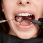 Reparar dientes dañados con inlay dental a medida