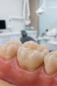 Onlay dental de porcelana conservando gran parte del diente natural