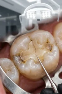 Empaste dental antiguo con signos de desgaste y pequeñas fisuras.