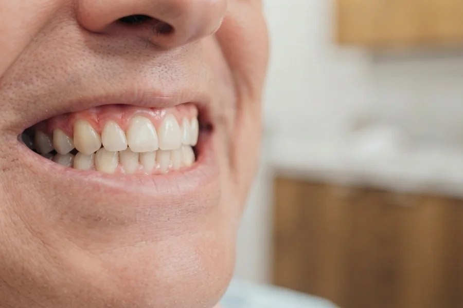 Encías inflamadas como signo de enfermedad periodontal