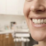Carillas dentales para mejorar la apariencia de la sonrisa