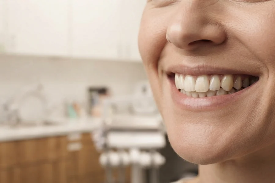 Carillas dentales para mejorar la apariencia de la sonrisa