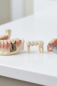 Modelos dentales que representan un implante, un puente fijo y una prótesis parcial removible.